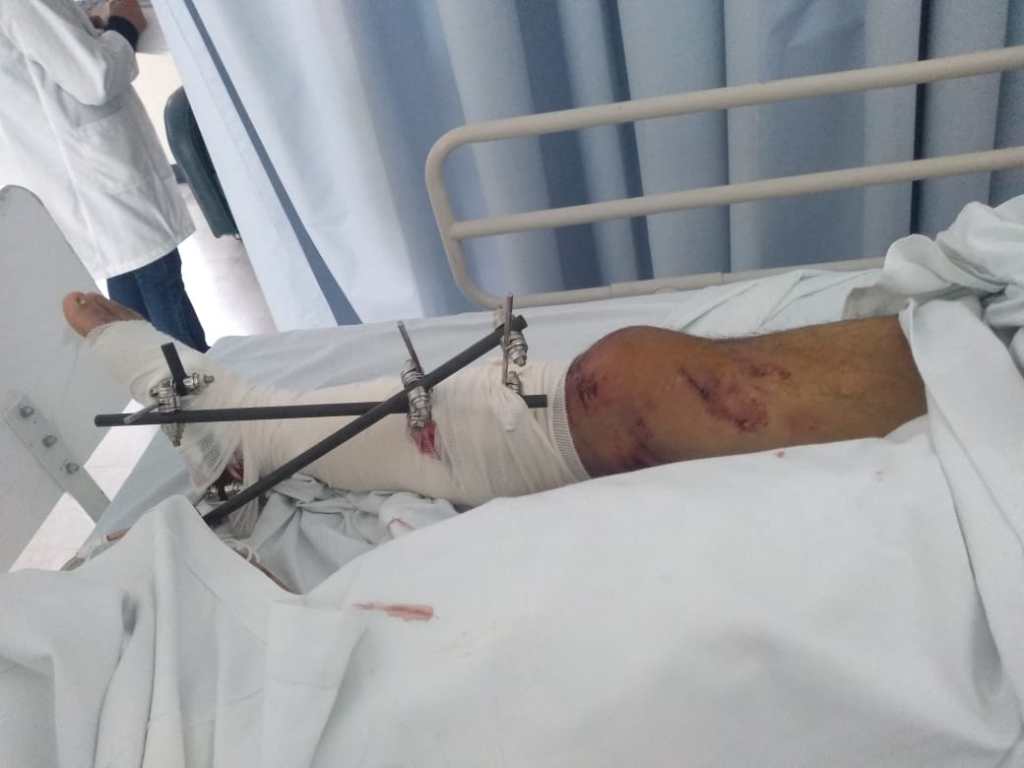 Taxista atropelló a motociclista en la Toluca-Palmillas y se dio a la fuga: la víctima perderá una&nbsp;pierna